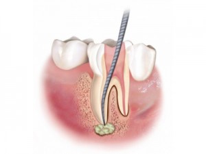 Nuovi sistemi per l’endodonzia