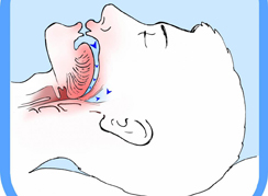 La sindrome delle apnee notturne OSAS un impegno multidisciplinare