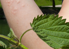 Focus on orticaria: attualità e controversie