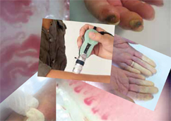 Le complicanze della sclerosi sistemica (sclerodermia): ulcere digitali e ipertensione polmonare